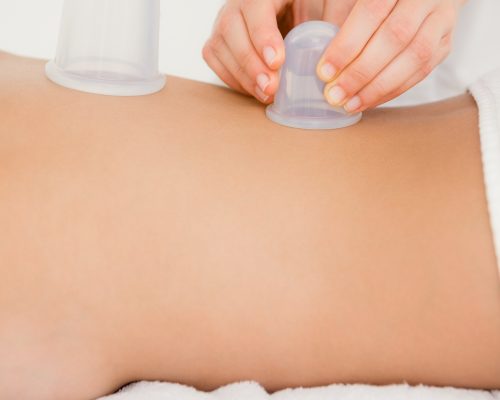 Woman with vacuum cups on her back at the health spa